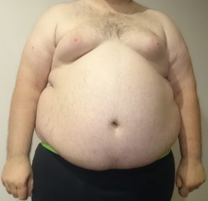 Obese Man in United States